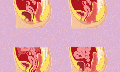 Descentes d’organes prolapsus